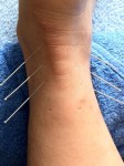 acupuncture-web